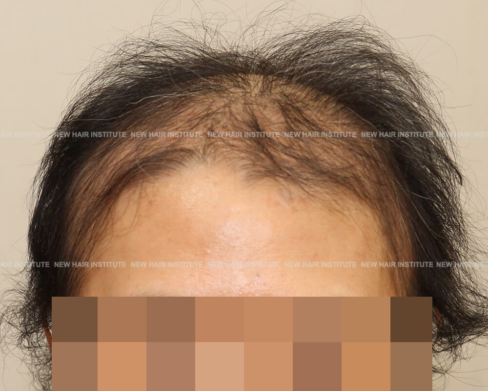 hair loss _ hair growth wall