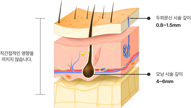 시술 후 두피와 모낭에 손상이 가지 않을까요?