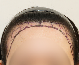 성형외과 의사 선생님이 개인의 비율과 모양을 분석하여 맞춤형 디자인합니다