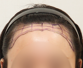 성형외과 의사 선생님이 개인의 비율과 모양을 분석하여 맞춤형 디자인합니다