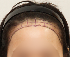 성형외과 의사 선생님이 개인의 비율과 모양을 분석하여 맞춤형 디자인합니다