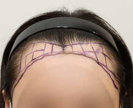 성형외과 의사 선생님이 개인의 비율과 모양을 분석하여 맞춤형 디자인합니다