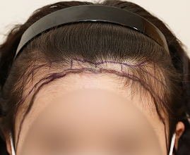 성형외과 의사 선생님이 개인의 비율과 모양을 분석하여 맞춤형 디자인합니다