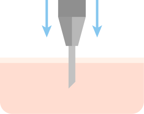 이식 부위에 모공 만들기