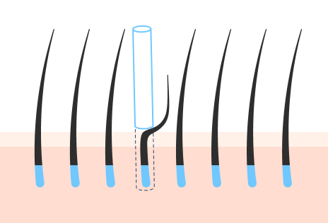 완전 무삭발 비절개