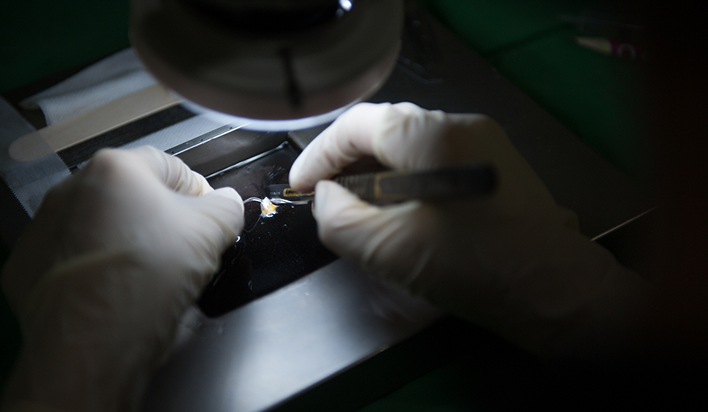 이식 모낭 아쿠아 컷팅